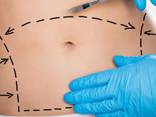 Abdominoplasty