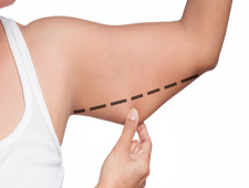 Brachioplasty