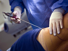 Liposuction