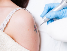 Tattoo Removal