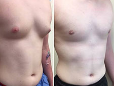 Gynecomastia surgery
