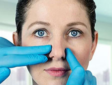 Nasal tip modification