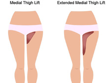 Thigh lift